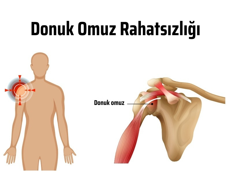 donuk omuz tipleri