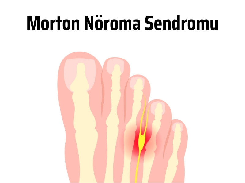 morton nöroma