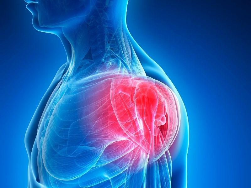 rotator cuff yırtılması